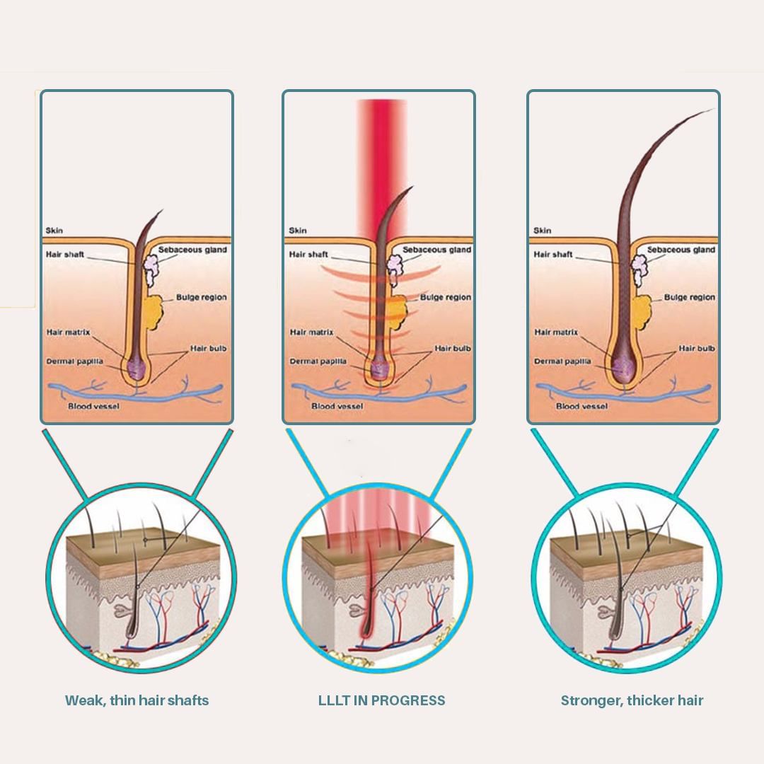 Laser Cap with 108 Laser Diodes | US FDA Approved | Hair Loss Treatment at Home