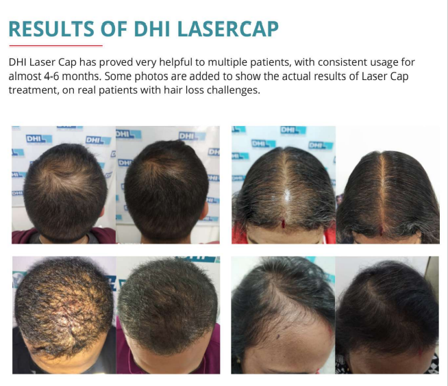 DHI Laser Cap with 272 Laser Diodes | FDA Approved & Clinically Proven Hair Loss Treatment at Home | Best Low Level Laser Therapy For Hair Regrowth In Men & Women